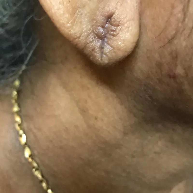 Ear Lobe After