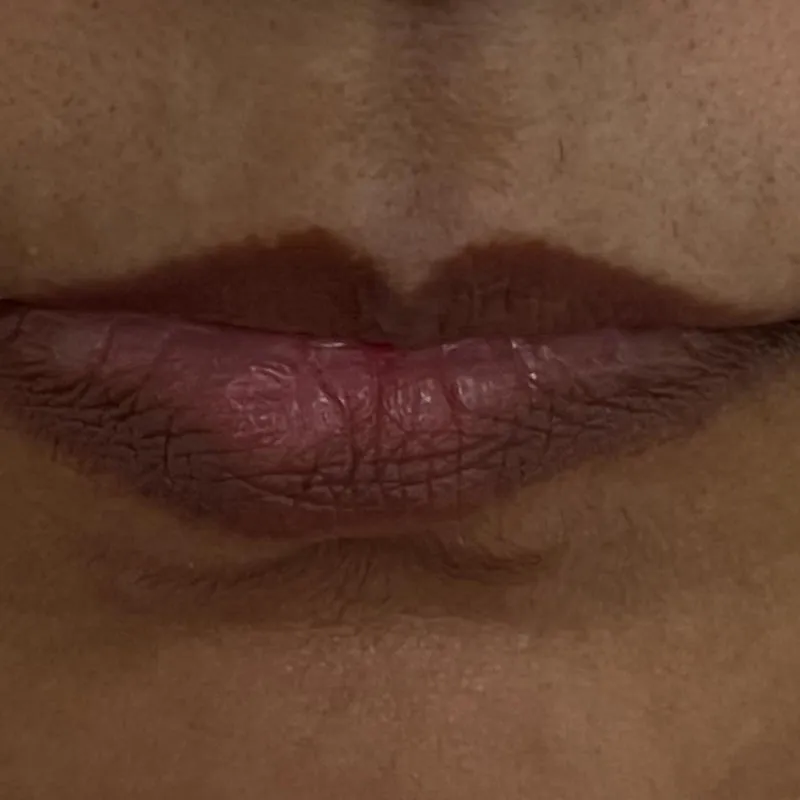 Lip Augmentation Before