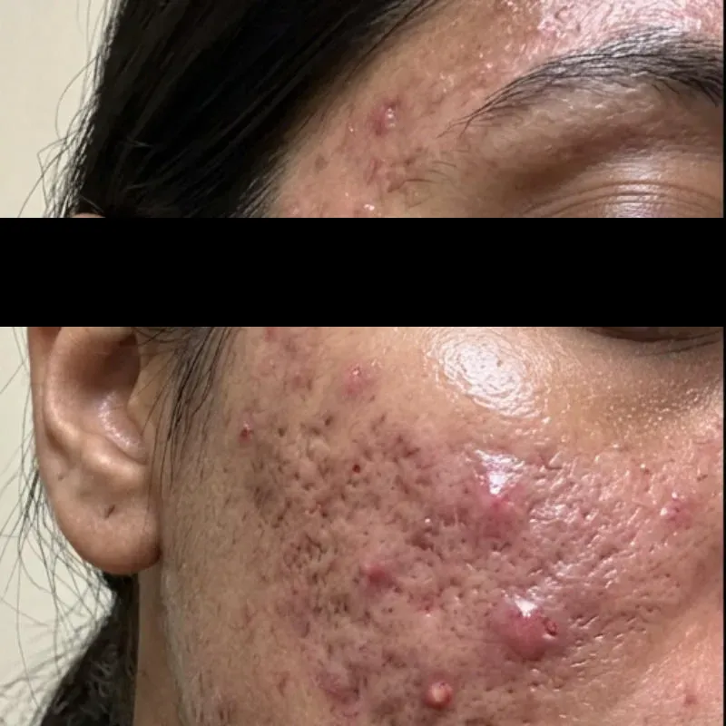 Acne Scar Before